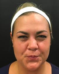 Best BOTOX Chicago