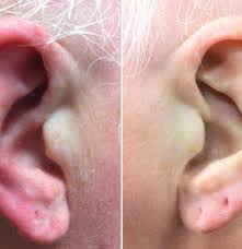 They can be quite painful due to inflammation and fluid. Red Ears Symptoms Causes And Treatment