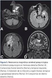 Mucormycosis is a rare, severe infection with fungi of the order mucorales. Tratamiento Exitoso De Mucormicosis Rino Orbito Cerebral En Un Paciente Trasplantado Renal