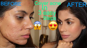 acne scars with makeup