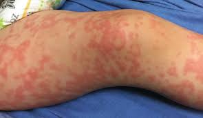 Image result for Erythema Multiforme Causes