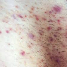 The bumps are all over the pores on my legs. Laser Hair Removal Reading Berkshire Chiltern Medical Clinics