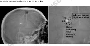 Figure 7 From Imaging Of Ventricular Shunts Semantic Scholar