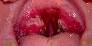 Image result for Strep throat infection roof of mouth