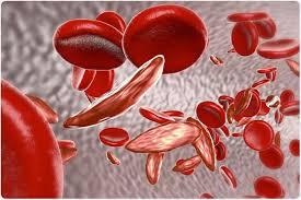 That's the protein in red blood cells that carries oxygen to the tissues of the body. Sickle Cell Disease Pathophysiology