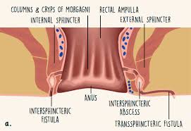 They can develop anywhere between an intestine and the skin. What Is A Fistula And Why Does It Occur With Crohn S Disease
