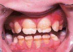 Enamel Hypoplasia Wikipedia