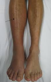 Symptoms Of Blood Clot In Leg Myheart