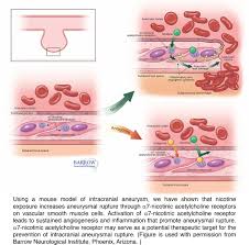 An aneurysm is a bulging, weakened area in the wall of a blood vessel resulting in an abnormal the most common location of an aneurysm is the aorta, which carries oxygenated blood from the heart to. Roles Of Nicotine In The Development Of Intracranial Aneurysm Rupture Stroke