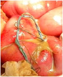 Image result for Pica