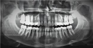 The term aneurysmal refers to the explosive, expansile nature of the bone containing the aneurysmal bone cyst, similar to the enlargement seen with blood vessel or heart. Traumatic Bone Cyst Of Anterior Mandible A Surgical Approach