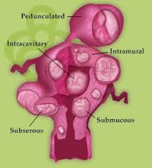 Quick growth of the fibroid Uterine Fibroids Fibroids And Heavy Bleeding Infertility