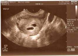 You have a placenta and a gestational sac, but the embryo doesn't grow. Twins Or Blighted Ovum