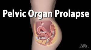 Pelvic Organ Prolapse, Animation - YouTube