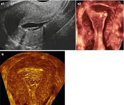 People who have had polyps in the past are somewhat more likely to develop them in the future, compared to uterine polyps have roughly a 5 percent chance of being related to cancer (malignant), while fibroids have less than a 1 percent likelihood of malignancy.410. Endometrial Polyps Radiology Key