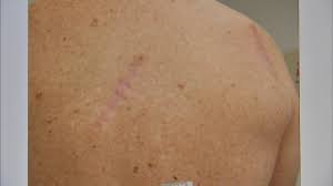 Skin cancer is by far the most common type of cancer. Melanoma Monday Skin Cancer Symptoms Types Prevention As Doctors Recommend Getting Checked Soon Abc7 Chicago