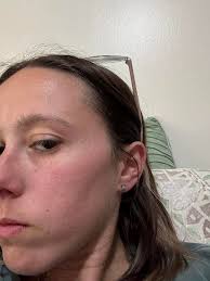 Hey guys! Lately I've been getting this redness