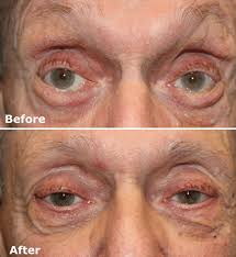 Image result for Entropion