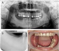 Numb Chin With Mandibular Pain Or Masticatory Weakness As Indicator For Systemic Malignancy A Case Series Study Sciencedirect