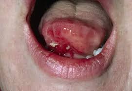 Image result for mouth ulcer on tongue)