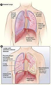 If cancer cells are found, special tests might be done to see if the cancer is a mesothelioma, a lung cancer, or another type of cancer. Asbestos Related Diseases Wikipedia