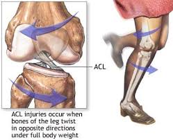 A pop, followed by pain and swelling of the knee are the most common symptoms of an acl tear. Acl Injury Active Care Physiotherapy Clinic