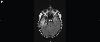 Imaging findings in patients with these disorders can also be quite variable, but recognizing characteristic findings within limbic structures suggestive of autoimmune encephalitis can be a key. Herpes Simplex Encephalitis An Unusual Cause Of Sinus Node Dysfunction Case Report And Literature Review International Journal Of Clinical Cardiology Clinmed International Library