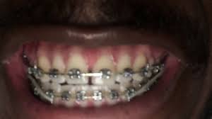It's a good question and it's a valid question. Gaps In Teeth Diastema Closure With And Without Braces
