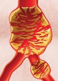 Dalam kasus aneurisma otak kecil. Aneurisma De Aorta Cirugia Cardiovascular Que Es Un Aneurisma