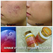 Intravenous vitamin c administration reduces fatigue in office workers: Serbuk Vitamin C Advance Home Facebook