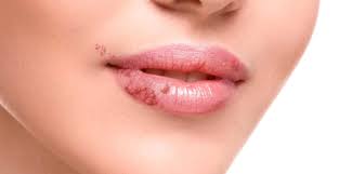 Întreabă ce nu ştii să faci din temă. P Herpes La GurÄ AflÄ Cum IÅ£i Vindeci Rapid Leziunile