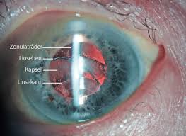 Image result for Lens Dislocation