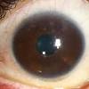 The cause of sarcoidosis is unknown. Https Encrypted Tbn0 Gstatic Com Images Q Tbn And9gcrffbd6otzlp7g94vspx2l9hsa8tjfg0nncvwak3ihdxlomvzhu Usqp Cau