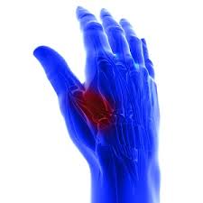 Image result for Intersection Syndrome