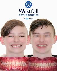 ✨ Transformation Tuesday ✨ Big smiles for Ben! 😁 After just 18 months of  treatment with Dr. Westfall, his cross-bite is fully corrected—without  needing an expander! 🙌 Using the @ocorthodontics Pitts Pro