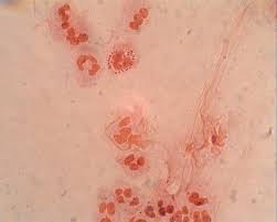 Das rasieren der schamhaare ist eine mögliche ursache für follikulitis. Dr Nabielek Gynakologie Infektionen Dermatosen
