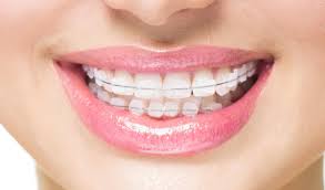 Clip on braces for teeth. How Can I Straighten My Teeth Straightening Options And Methods