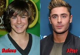 Some people telling zac efron botched surgery photo is fake. Zac Efron Plastic Surgery A New Look For Teen Heartthrob