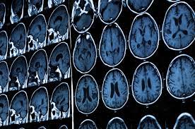 In elderly people with cognitive deficits, brain imaging can help differentiate neurodegenerative diseases, such as alzheimer's disease and other dementias, from depression. Could Brain Scans Help Predict Schizophrenia News Cardiff University