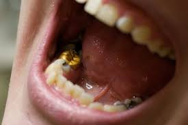 Depending upon the size of the cavity and the type of restorative material used it may take 30 to 60 minutes on average to fill a tooth. Dental Fillings 101 Answers To Your Top Questions About Getting Cavities Filled Downtown Toronto Dentist Toronto Dentistry Soho Dental