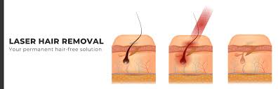 Both work by targeting hair follicles located under the skin's surface. Laser Hair Removal Your Permanent Hair Free Solution Ozhean A M Clinic