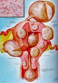 Medical diagram of the uterus showing fibroids in different locations treated by myomectomy