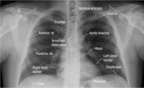 Because some conditions of the chest. Interpreting A Chest X Ray British Journal Of Hospital Medicine