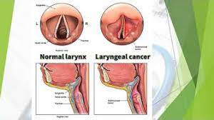 Cancer that starts in the head and neck area can have many different names depending on where the cancer starts. Tongue Cancer Symptoms How To Know If You Have It With 2 Ideas On Preventing It Throat Cancer Normal Throat Vs Cancer Throat What Causes Throat Youtube