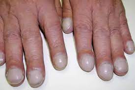 肥厚性骨关节病可能是肺部疾病和心脏疾病的征兆_指甲_手指_包括