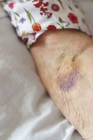 Hemostasis includes clotting of the blood. Blood Clot In Arm Symptoms Is It Dangerous Causes And Treatment