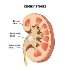 Kidney Stones Nephrolithiasis