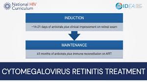 Image result for HIV Retinitis