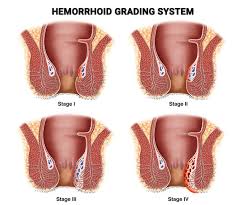 Image result for hemoroid human