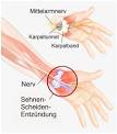 Sehnenentzundung handgelenk behandlung
